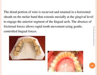69
The distal portion of wire is recurved and retained in a horizontal
sheath on the molar band that extends mesially at the gingival level
to engage the anterior segment of the lingual arch. The absence of
frictional forces allows rapid tooth movement using gentle,
controlled lingual forces.
DrRavikanthLakkakula
 