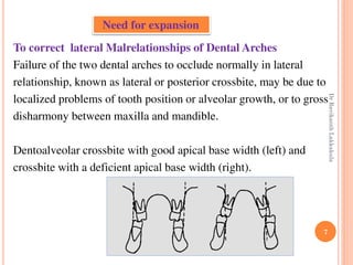 7
To correct lateral Malrelationships of Dental Arches
Failure of the two dental arches to occlude normally in lateral
relationship, known as lateral or posterior crossbite, may be due to
localized problems of tooth position or alveolar growth, or to gross
disharmony between maxilla and mandible.
Dentoalveolar crossbite with good apical base width (left) and
crossbite with a deficient apical base width (right).
Need for expansion
DrRavikanthLakkakula
 