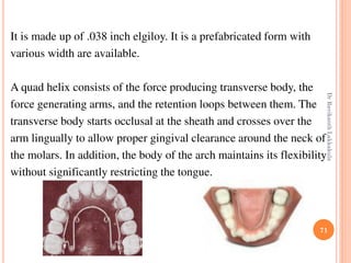71
It is made up of .038 inch elgiloy. It is a prefabricated form with
various width are available.
A quad helix consists of the force producing transverse body, the
force generating arms, and the retention loops between them. The
transverse body starts occlusal at the sheath and crosses over the
arm lingually to allow proper gingival clearance around the neck of
the molars. In addition, the body of the arch maintains its flexibility
without significantly restricting the tongue.
DrRavikanthLakkakula
 