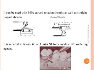 72
It can be used with MIA curved rotation sheaths as well as straight
lingual sheaths.
It is secured with wire tie or Alastik S1 force module. No soldering
needed.
DrRavikanthLakkakula
 