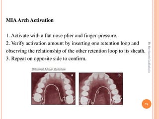 74
MIAArch Activation
1. Activate with a flat nose plier and finger-pressure.
2. Verify activation amount by inserting one retention loop and
observing the relationship of the other retention loop to its sheath.
3. Repeat on opposite side to confirm.
DrRavikanthLakkakula
 