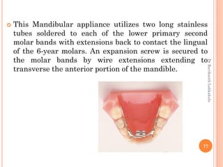 77
 This Mandibular appliance utilizes two long stainless
tubes soldered to each of the lower primary second
molar bands with extensions back to contact the lingual
of the 6-year molars. An expansion screw is secured to
the molar bands by wire extensions extending to
transverse the anterior portion of the mandible.
DrRavikanthLakkakula
 