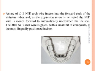 78
 An arc of .016 NiTi arch wire inserts into the forward ends of the
stainless tubes and, as the expansion screw is activated the NiTi
wire is moved forward to automatically uncrowded the incisors.
The .016 NiTi arch wire is glued, with a small bit of composite, to
the most lingually positioned incisor.
DrRavikanthLakkakula
 