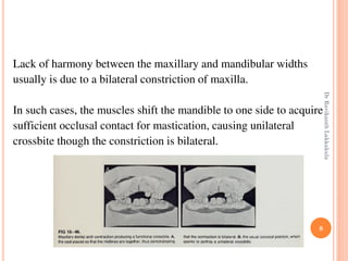 8
Lack of harmony between the maxillary and mandibular widths
usually is due to a bilateral constriction of maxilla.
In such cases, the muscles shift the mandible to one side to acquire
sufficient occlusal contact for mastication, causing unilateral
crossbite though the constriction is bilateral.
DrRavikanthLakkakula
 