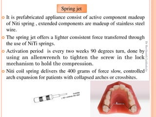 81
 It is prefabricated appliance consist of active component madeup
of Niti spring , extended components are madeup of stainless steel
wire.
 The spring jet offers a lighter consistent force transferred through
the use of NiTi springs.
 Activation period is every two weeks 90 degrees turn, done by
using an allenwrench to tighten the screw in the lock
mechanism to hold the compression.
 Niti coil spring delivers the 400 grams of force slow, controlled
arch expansion for patients with collapsed arches or crossbites.
Spring jet
DrRavikanthLakkakula
 