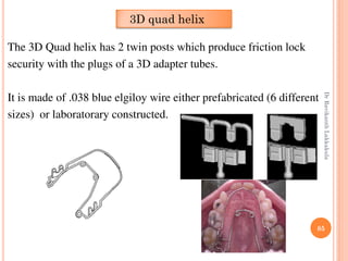85
The 3D Quad helix has 2 twin posts which produce friction lock
security with the plugs of a 3D adapter tubes.
It is made of .038 blue elgiloy wire either prefabricated (6 different
sizes) or laboratorary constructed.
3D quad helix
DrRavikanthLakkakula
 