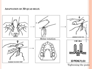 ADAPTATION OF 3D QUAD HELIX
Molar rotation
Tightening the posts
87
DrRavikanthLakkakula
 