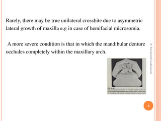 9
Rarely, there may be true unilateral crossbite due to asymmetric
lateral growth of maxilla e.g in case of hemifacial microsomia.
A more severe condition is that in which the mandibular denture
occludes completely within the maxillary arch.
DrRavikanthLakkakula
 