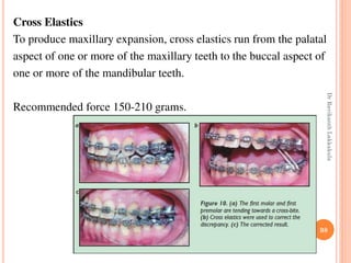 Cross Elastics
To produce maxillary expansion, cross elastics run from the palatal
aspect of one or more of the maxillary teeth to the buccal aspect of
one or more of the mandibular teeth.
Recommended force 150-210 grams.
98
DrRavikanthLakkakula
 