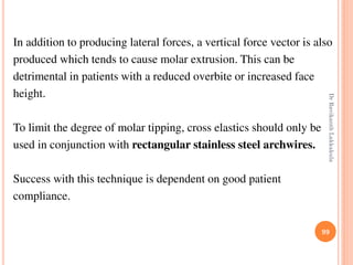 In addition to producing lateral forces, a vertical force vector is also
produced which tends to cause molar extrusion. This can be
detrimental in patients with a reduced overbite or increased face
height.
To limit the degree of molar tipping, cross elastics should only be
used in conjunction with rectangular stainless steel archwires.
Success with this technique is dependent on good patient
compliance.
99
DrRavikanthLakkakula
 