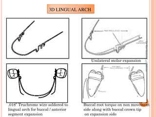 3D LINGUAL ARCH
Unilateral molar expansion
Buccal root torque on non movement
side along with buccal crown tip
on expansio...