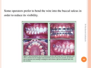Some operators prefer to bend the wire into the buccal sulcus in
order to reduce its visibility.
96
DrRavikanthLakkakula
 