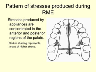 SME and RME procedure in orthodontics presentation | PPT