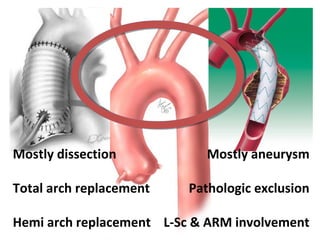 Mostly dissection
Total arch replacement
Hemi arch replacement
Mostly aneurysm
Pathologic exclusion
L-Sc & ARM involvement
 