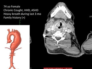 74 yo Female
Chronic Cought, HHD, ASHD
Heavy breath during last 3 mo
Family history (+)
 