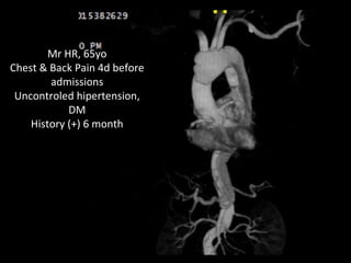 Mr HR, 65yo
Chest & Back Pain 4d before
admissions
Uncontroled hipertension,
DM
History (+) 6 month
 