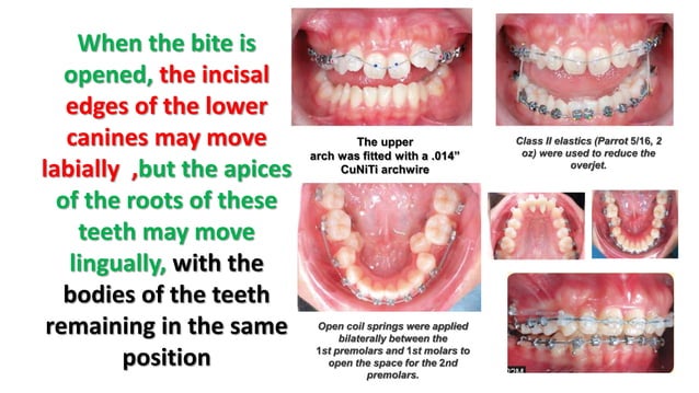 orthodontic arch form | PPTX | Dental Health | Diseases and Conditions