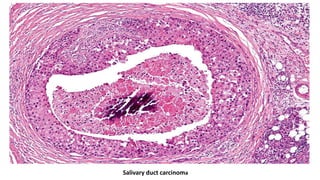 Salivary duct carcinoma
 