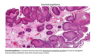 Inverted papilloma is characterized by prominent downward endophytic growth of round to elongated
interconnected epithelial nests with smooth outer contour
Inverted papilloma
 