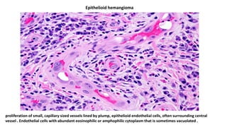 proliferation of small, capillary sized vessels lined by plump, epithelioid endothelial cells, often surrounding central
vessel . Endothelial cells with abundant eosinophilic or amphophilic cytoplasm that is sometimes vacuolated .
Epithelioid hemangioma
 