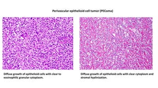 Perivascular epithelioid cell tumor (PEComa)
Diffuse growth of epithelioid cells with clear to
eosinophilic granular cytoplasm.
Diffuse growth of epithelioid cells with clear cytoplasm and
stromal hyalinization.
 