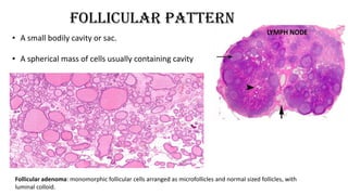 Follicular pattern
• A small bodily cavity or sac.
• A spherical mass of cells usually containing cavity
Follicular adenoma: monomorphic follicular cells arranged as microfollicles and normal sized follicles, with
luminal colloid.
 