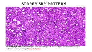 Burkitt lymphoma : Scattered tingible body macrophages with abundant pale cytoplasm-containing cell
debris are present, creating a “starry sky” pattern
Starry sky pattern
 