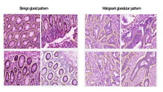 Benign gland pattern Malignant glandular pattern
 