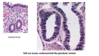 Yolk sac tumor, endometrioid-like glandular variant
ENDOMETRIUM
 