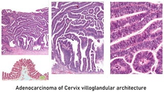 Adenocarcinoma of Cervix villoglandular architecture
 