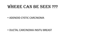 Where can be seen ???
• ADENOID CYSTIC CARCINOMA
• DUCTAL CARCINOMA INSITU BREAST
 