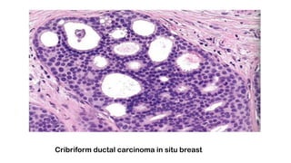 Cribriform ductal carcinoma in situ breast
 