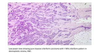 Low power view showing pure invasive cribriform carcinoma with > 90% cribriform pattern in
desmoplastic stroma, H&E.
 