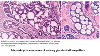 Adenoid cystic carcinoma of salivary gland cribriform pattern
Cribriform pattern is composed predominantly of myoepithelial cells admixed
with hyalinized or myxoid globules. Scattered ductal elements (arrows) may
also been present.
 