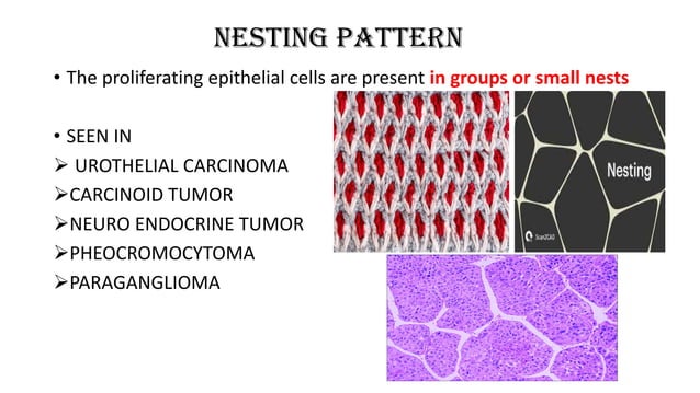 ARCHITECTURAL PATTERNS IN HISTOPATHOLOGY pdf- [Autosaved].pdf | Cancer ...