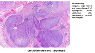 Urothelial carcinoma, large nests
Anastomosing,
irregular, large nested
and inverted growth of
cytologically bland
urothelium with
desmoplastic stromal
reaction (4x).
 