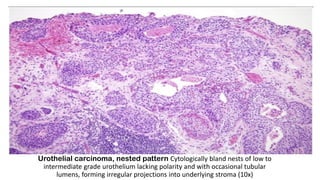 Urothelial carcinoma, nested pattern Cytologically bland nests of low to
intermediate grade urothelium lacking polarity and with occasional tubular
lumens, forming irregular projections into underlying stroma (10x)
 