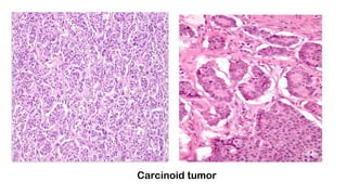 Carcinoid tumor
 