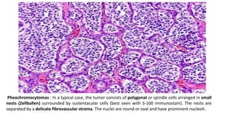 Pheochromocytomas : In a typical case, the tumor consists of polygonal or spindle cells arranged in small
nests (Zellballen) surrounded by sustentacular cells (best seen with S-100 immunostain). The nests are
separated by a delicate fibrovascular stroma. The nuclei are round or oval and have prominent nucleoli.
 