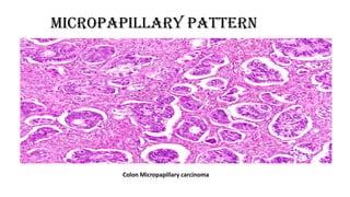 MICROPAPILLARY PATTERN
Colon Micropapillary carcinoma
 