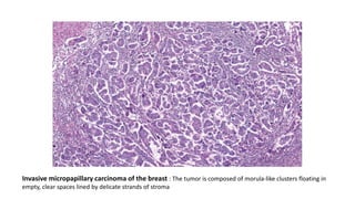 Invasive micropapillary carcinoma of the breast : The tumor is composed of morula-like clusters floating in
empty, clear spaces lined by delicate strands of stroma
 