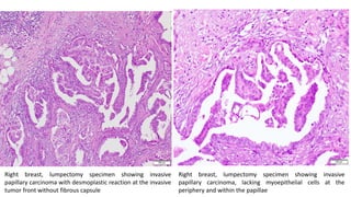 Right breast, lumpectomy specimen showing invasive
papillary carcinoma with desmoplastic reaction at the invasive
tumor front without fibrous capsule
Right breast, lumpectomy specimen showing invasive
papillary carcinoma, lacking myoepithelial cells at the
periphery and within the papillae
 