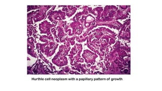 Hurthle cell neoplasm with a papillary pattern of growth
 