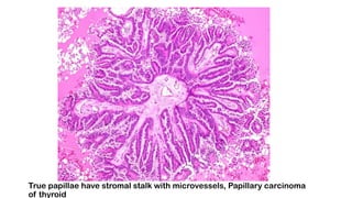 True papillae have stromal stalk with microvessels, Papillary carcinoma
of thyroid
 