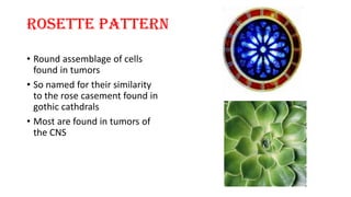 ROSETTE PATTERN
• Round assemblage of cells
found in tumors
• So named for their similarity
to the rose casement found in
gothic cathdrals
• Most are found in tumors of
the CNS
 