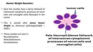 Homer Wright Rosettes:
• Here the rosettes have a dense feltwork of
interwoven cytoplasmic processes of nerve
cells and neuroglial cells( Neuropil) in the
centre.
• This is named after James Homer
Wright an American pathologist(1869 –
1928 )
• These rosettes are seen in
Neuroblastoma
Medulloblastoma
Pineoblastoma
 