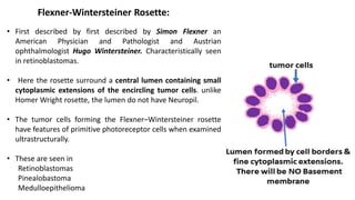 Flexner-Wintersteiner Rosette:
• First described by first described by Simon Flexner an
American Physician and Pathologist and Austrian
ophthalmologist Hugo Wintersteiner. Characteristically seen
in retinoblastomas.
• Here the rosette surround a central lumen containing small
cytoplasmic extensions of the encircling tumor cells. unlike
Homer Wright rosette, the lumen do not have Neuropil.
• The tumor cells forming the Flexner–Wintersteiner rosette
have features of primitive photoreceptor cells when examined
ultrastructurally.
• These are seen in
Retinoblastomas
Pinealobastoma
Medulloepithelioma
 