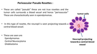 Perivascular Pseudo Rosettes :
• These are called “pseudo” these are not true rosettes and the
tumor cells surrounds a blood vessel and hence “perivascular”
These are charactestically seen in ependymomas.
• In this type of rosette, the neuropil is seen projecting towards a
central blood vessel.
• These are seen are
Ependymomas
Central Neurocytoma
Glioblastoma
 