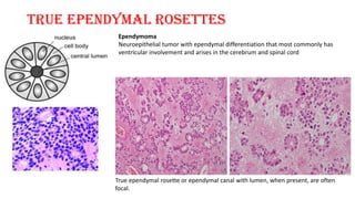 True ependymal rosettes
True ependymal rosette or ependymal canal with lumen, when present, are often
focal.
Ependymoma
Neuroepithelial tumor with ependymal differentiation that most commonly has
ventricular involvement and arises in the cerebrum and spinal cord
 