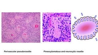 Perivascular pseudorosette Pineocytomatous and neurocytic rosette
 